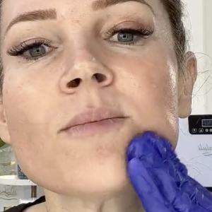 BIENPEEL 35 % TCA The No “Peel” Peel - treatment image