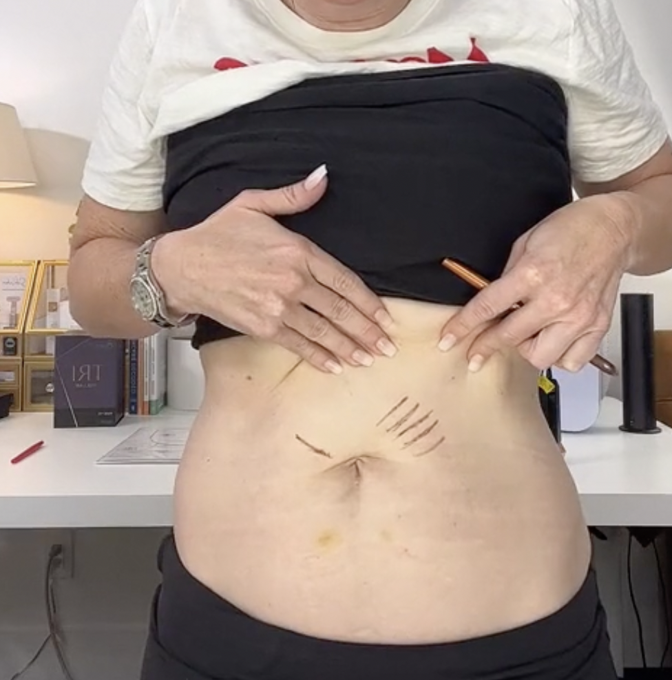 Can You Do Chemical Peels in the Summertime? - treatment image