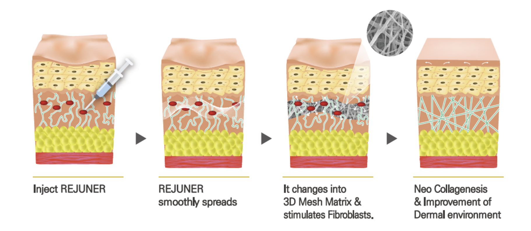Rejuner Black PCL and PCL THREADS - treatment image