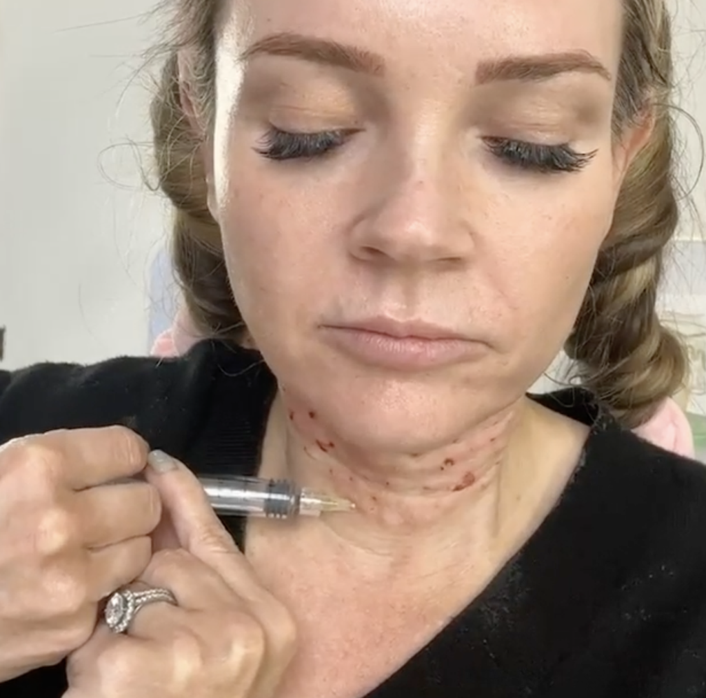 REGENOVUE AQUASHINE AND PCL THREADS | NECK REJUVENATION