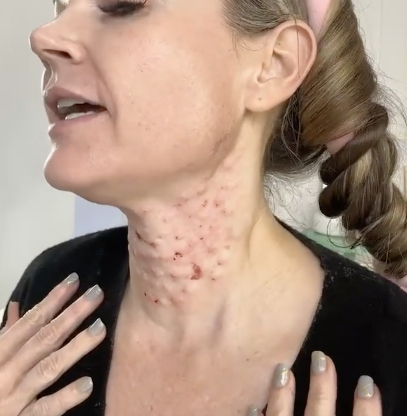 REGENOVUE AQUASHINE AND PCL THREADS | NECK REJUVENATION