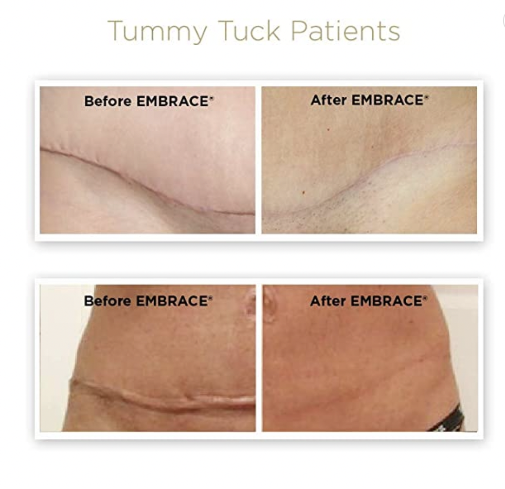 TUMMY TUCK POST OP NATURAL KAOS - treatment image