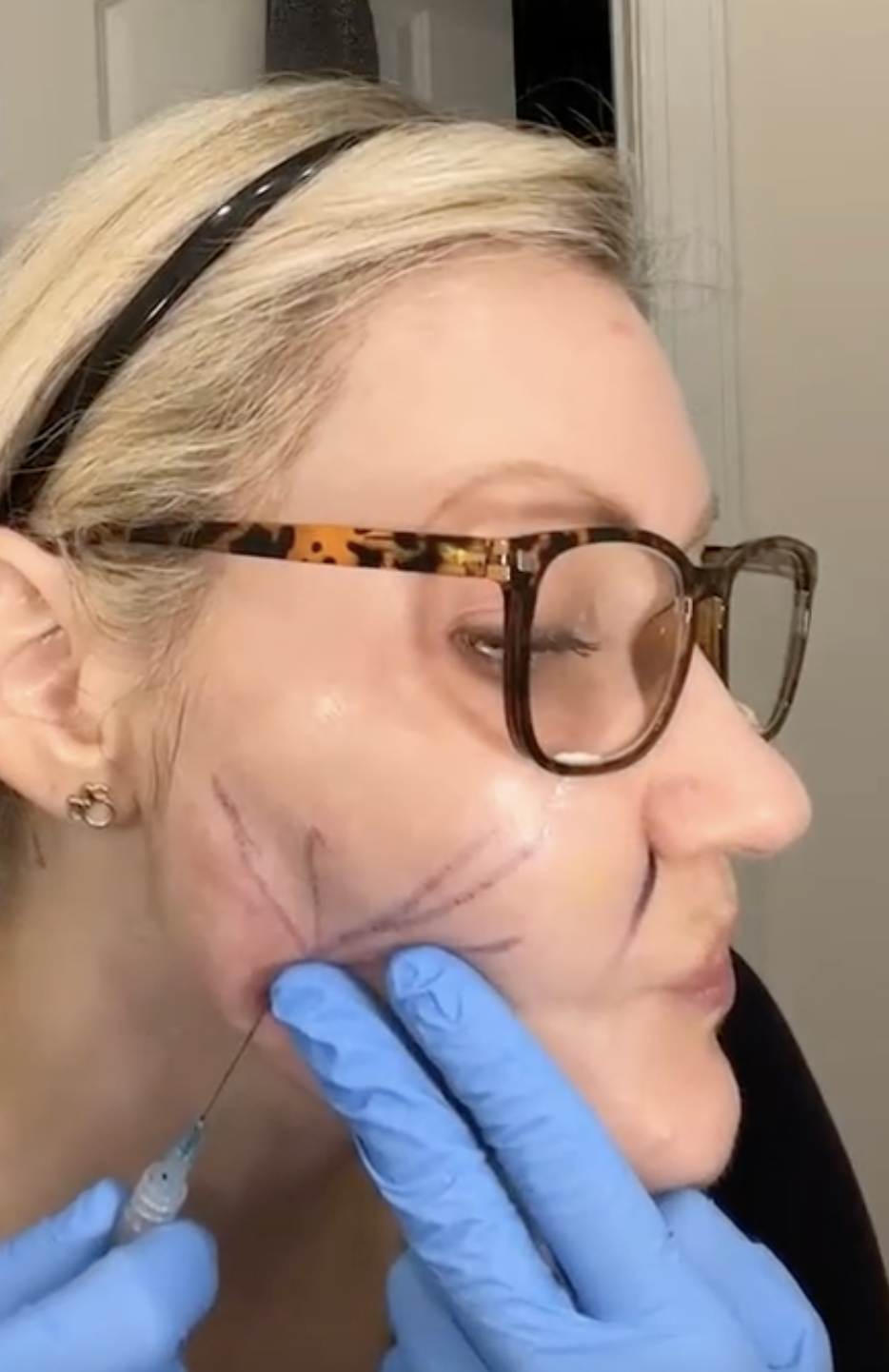 Rejubeau Stylish Le Ciel Rosy | PLLA FILLER - treatment image