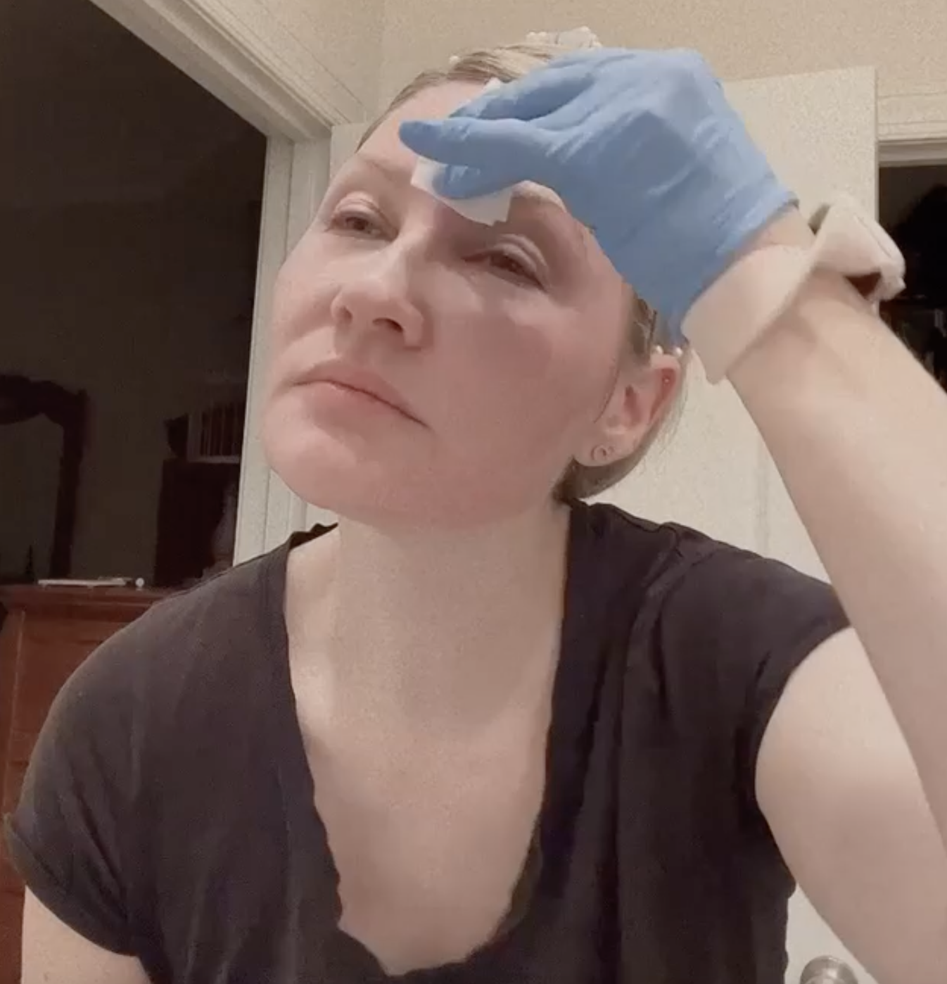 30% TCA PEEL | ADJUSTABLE PEEL