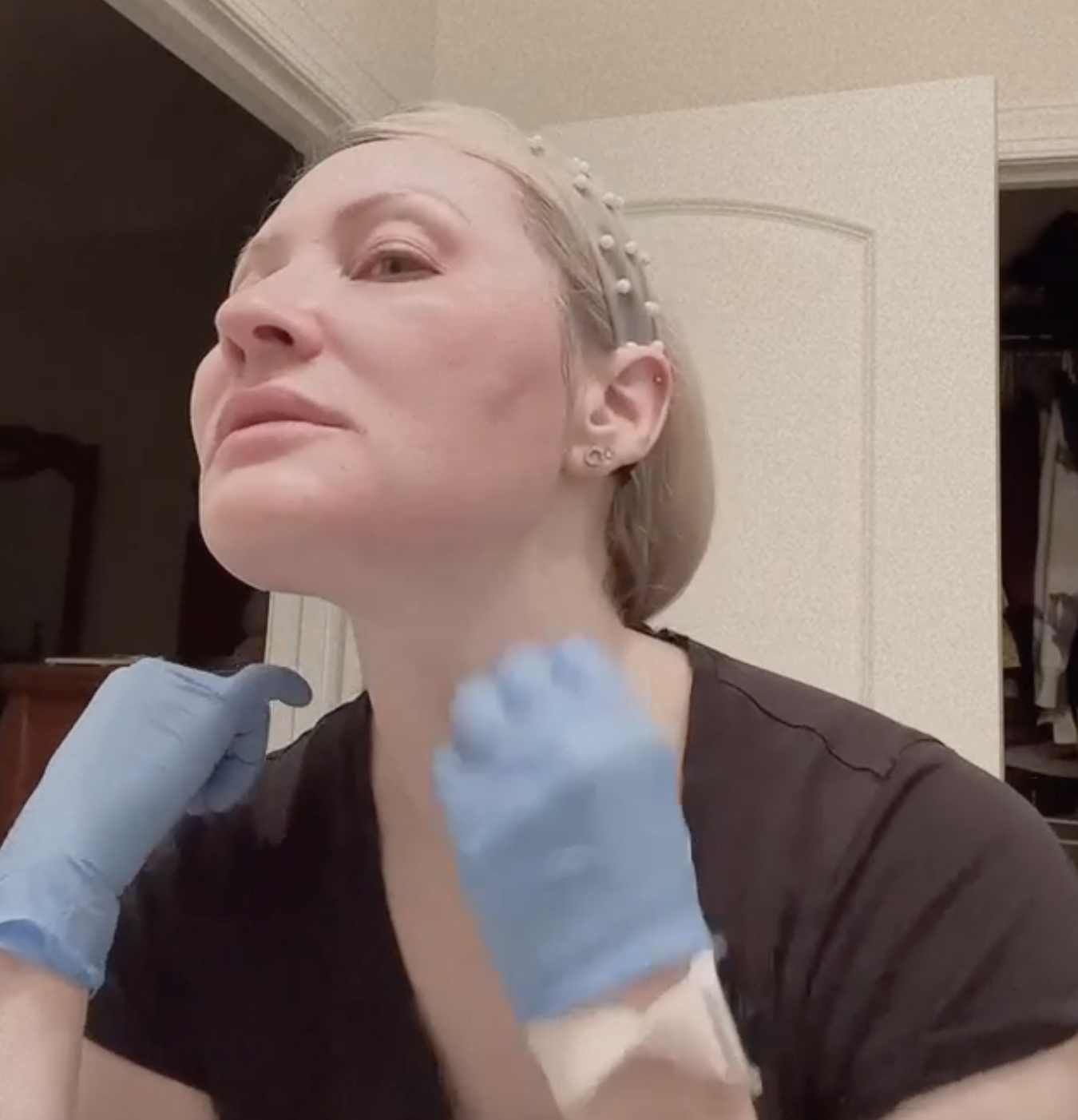 30% TCA PEEL | ADJUSTABLE PEEL - treatment image