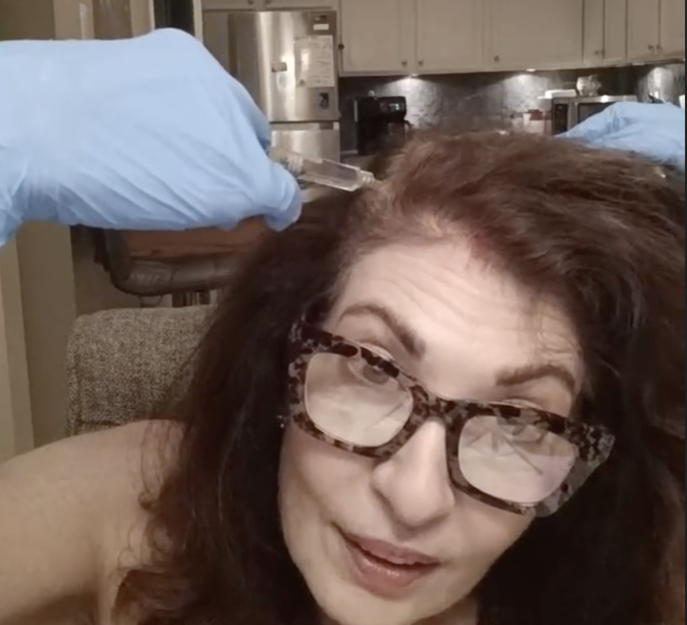 HAIRNA Exosome Hair Fill MESOTHERAPY - treatment image