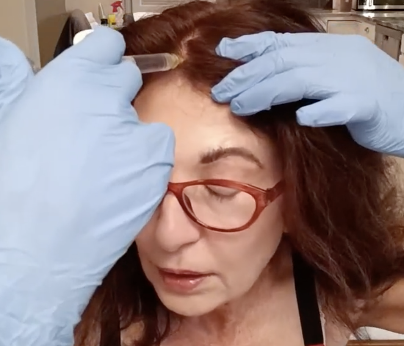 HAIRNA Exosome Hair Fill MESOTHERAPY