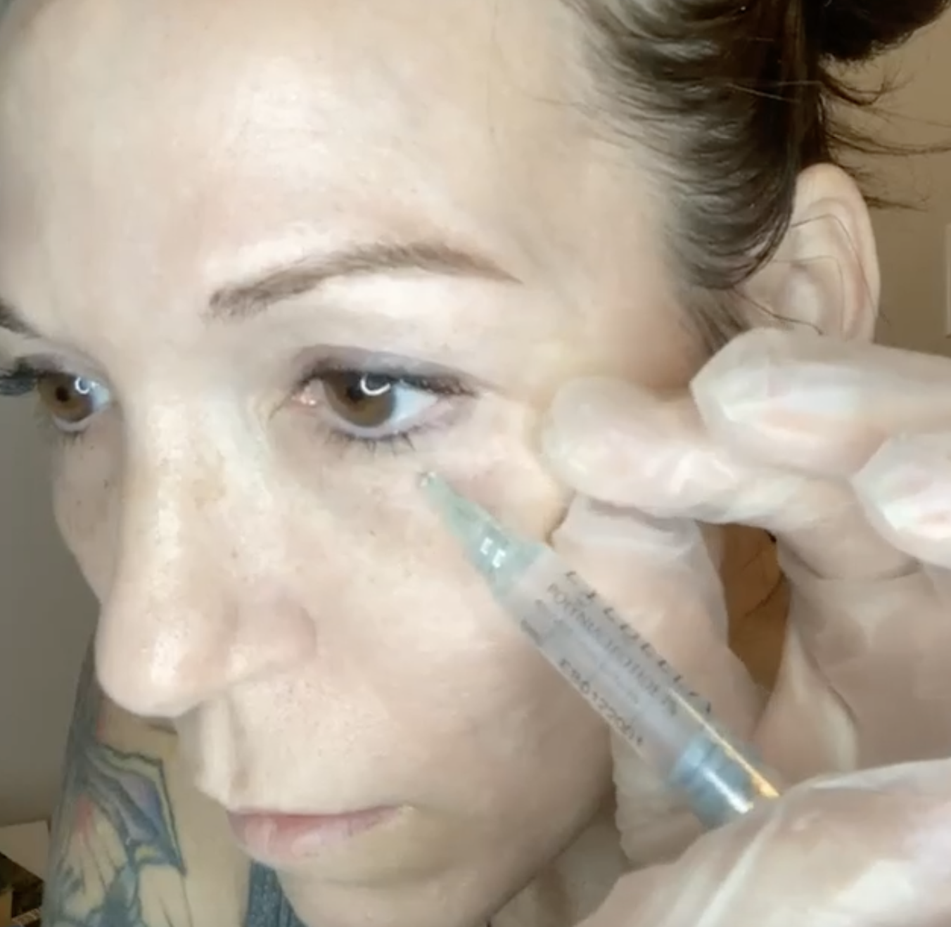EYEBELLA PN MESOTHERAPY - treatment image