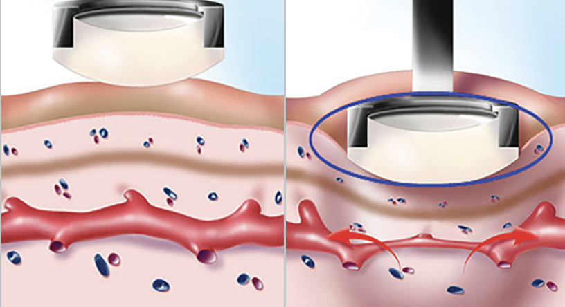 Tummy Tuck Before and After SCAR Check - treatment image
