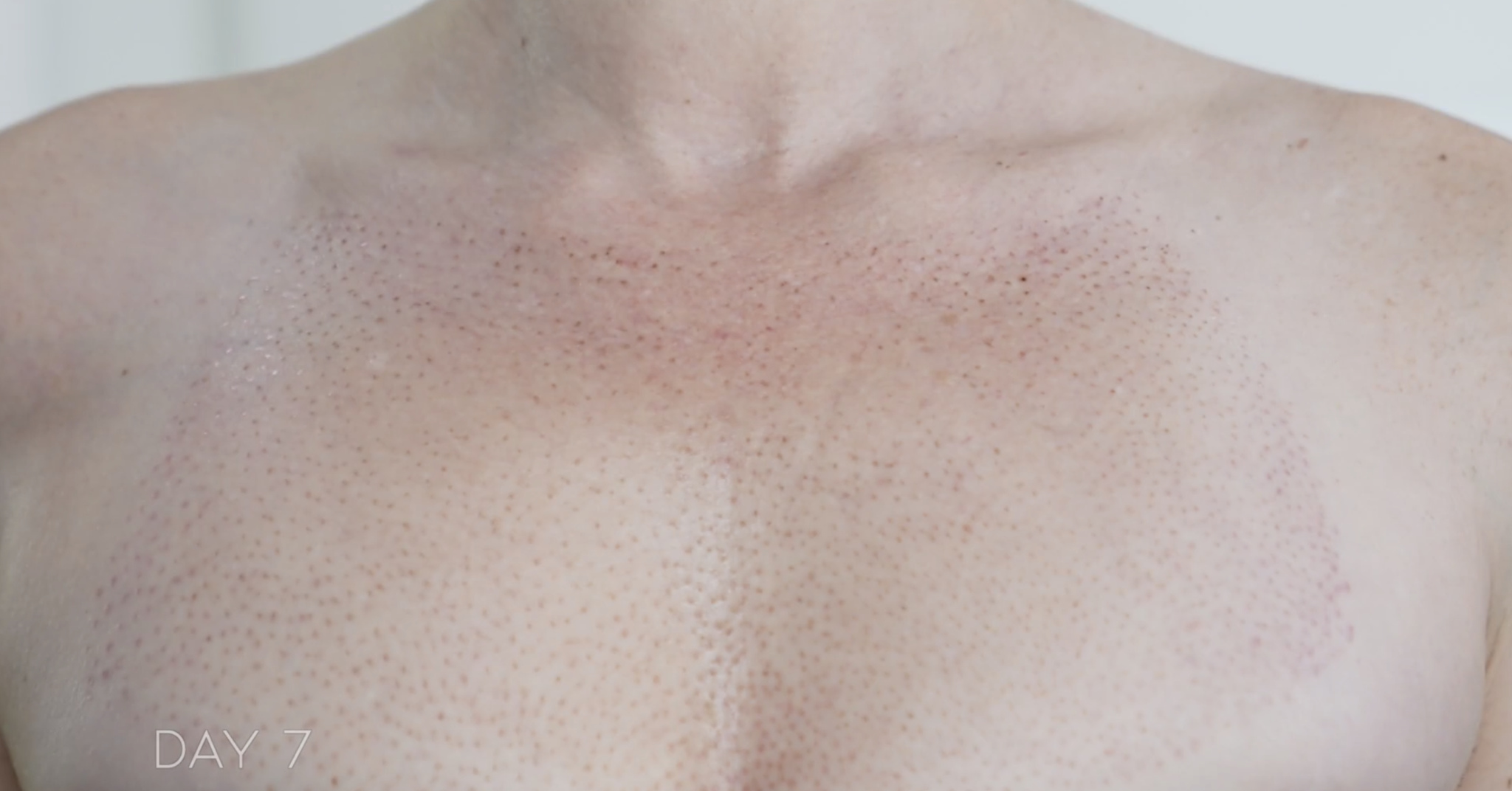 PLASMA FIBROBLAST CHEST- BEFORE AND AFTER - treatment image