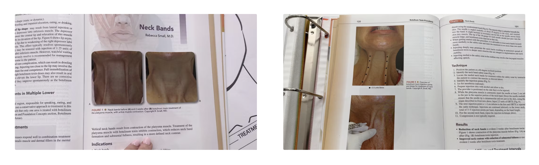 Ultimate Neck Tightening Treatment: PDO Threads & Innotox Combination - treatment image