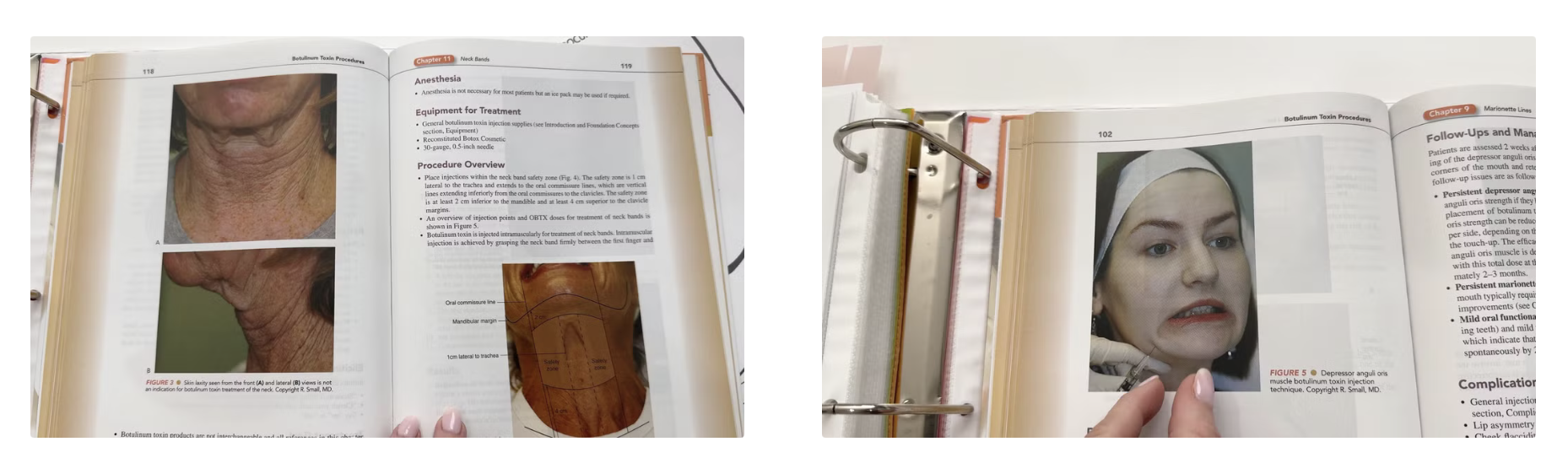 Ultimate Neck Tightening Treatment: PDO Threads & Innotox Combination - treatment image