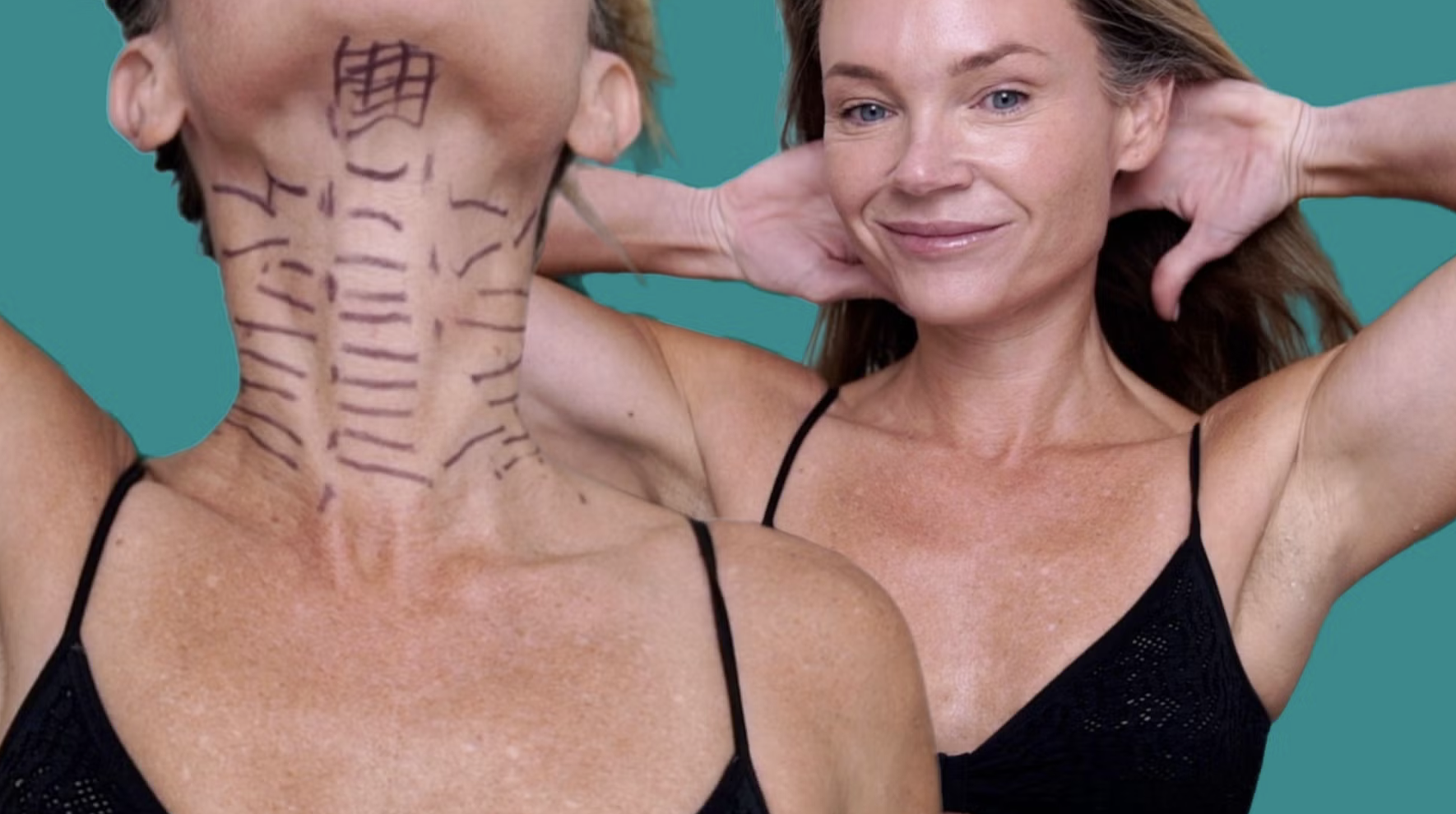 Ultimate Neck Tightening Treatment: PDO Threads & Innotox Combination