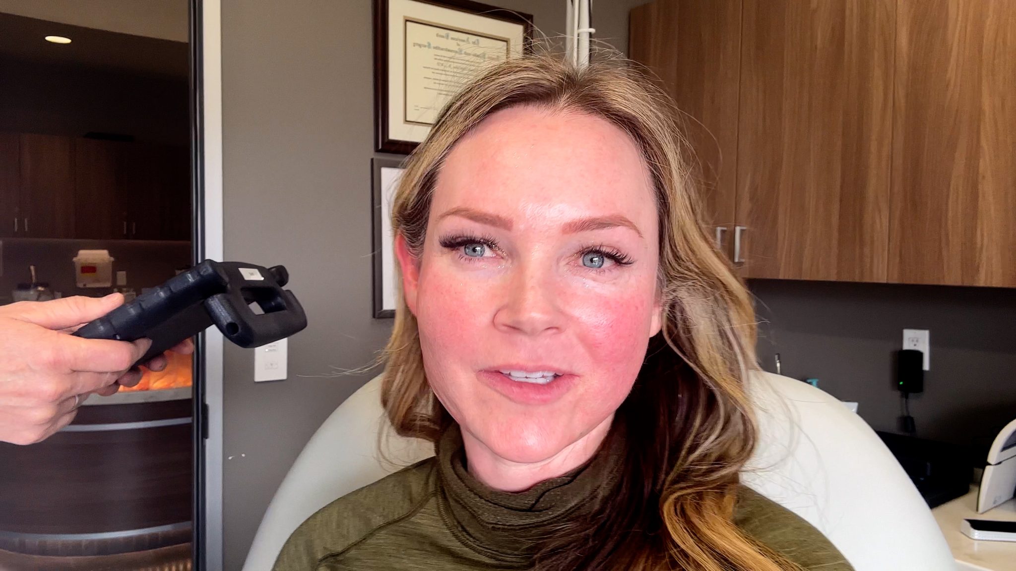 SCULPTRA 1 YEAR AFTER 4 VIALS COMPARISON - treatment image