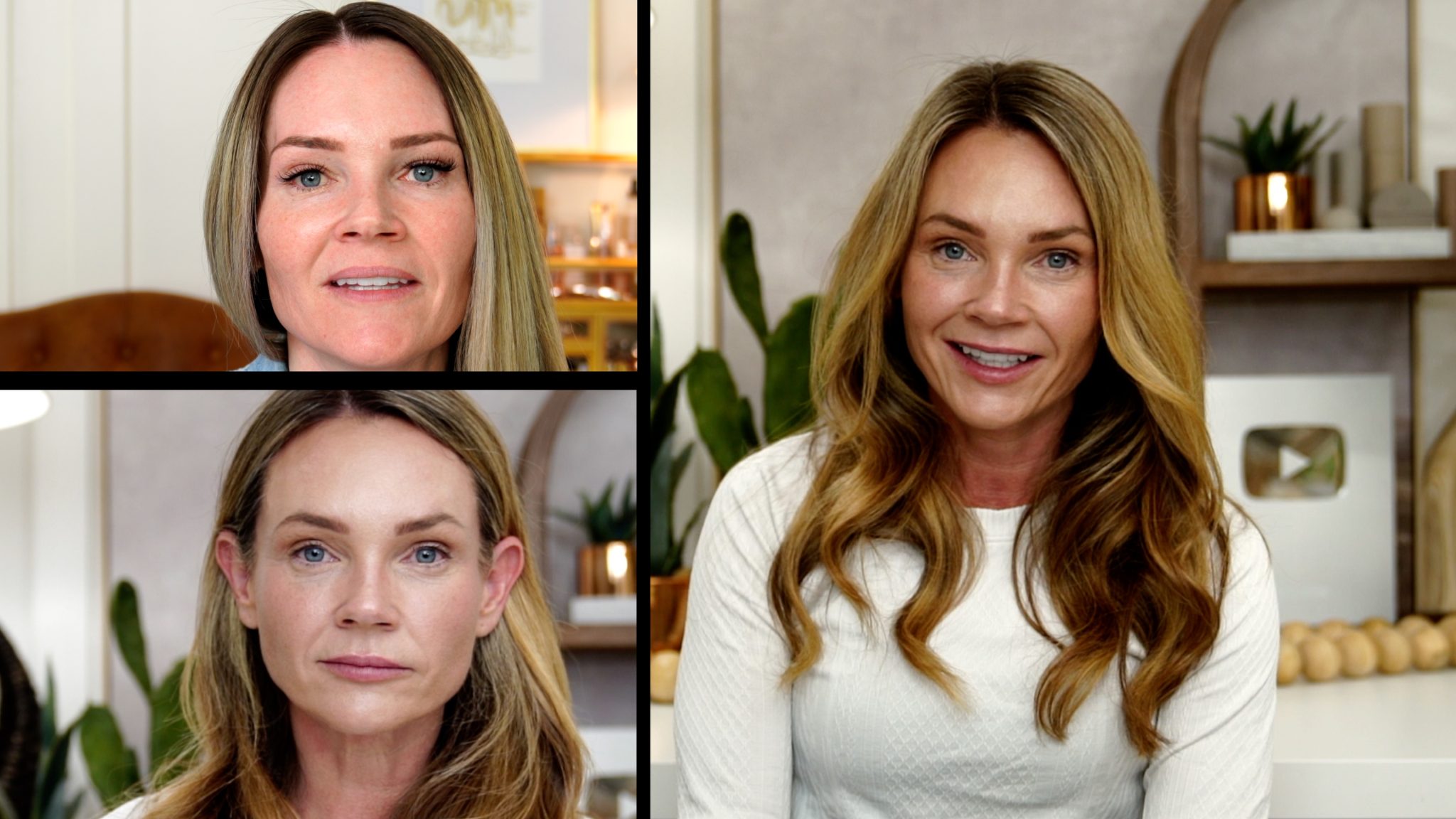 SCULPTRA 1 YEAR AFTER 4 VIALS COMPARISON - treatment image