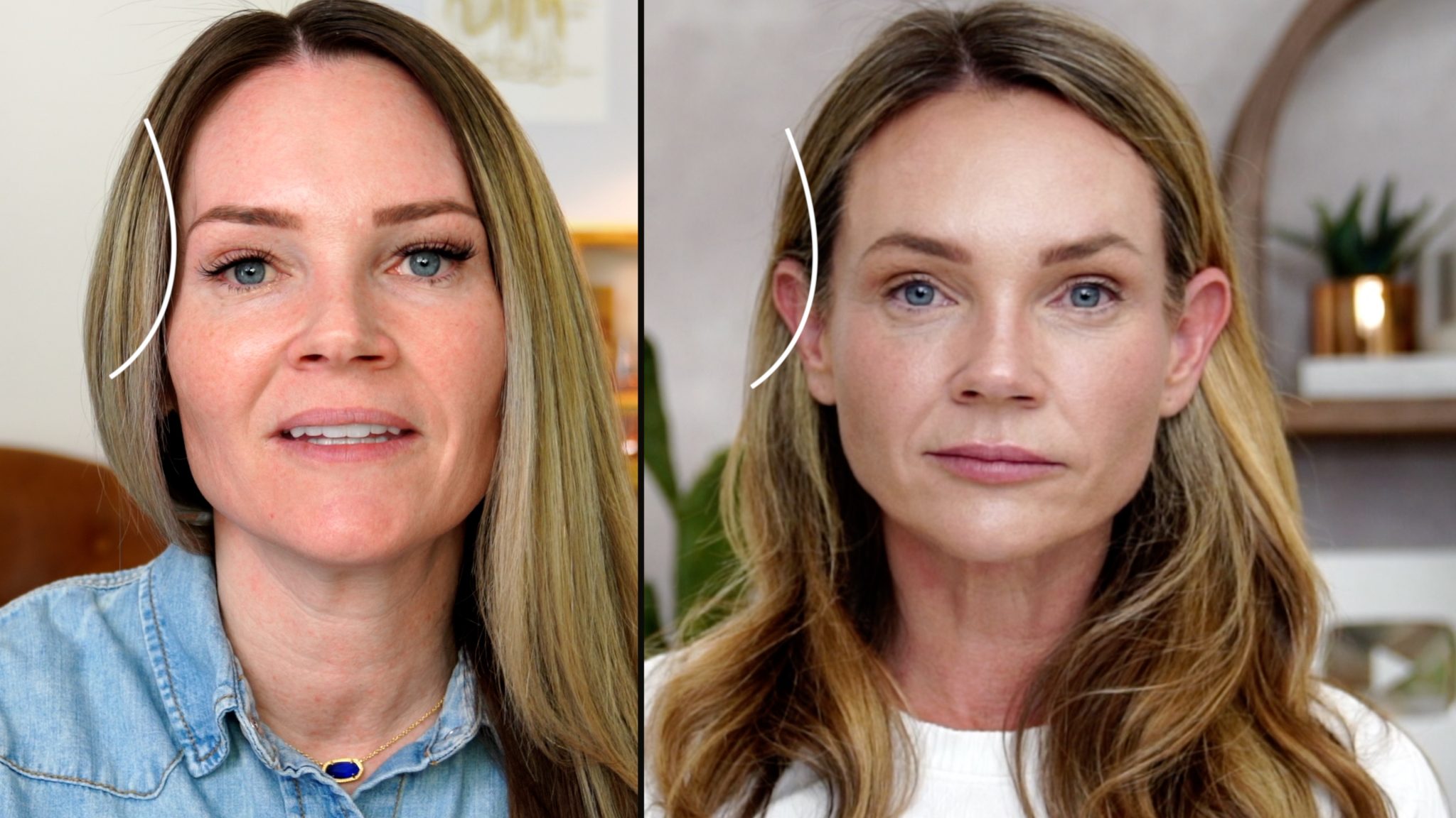 SCULPTRA 1 YEAR AFTER 4 VIALS COMPARISON - treatment image