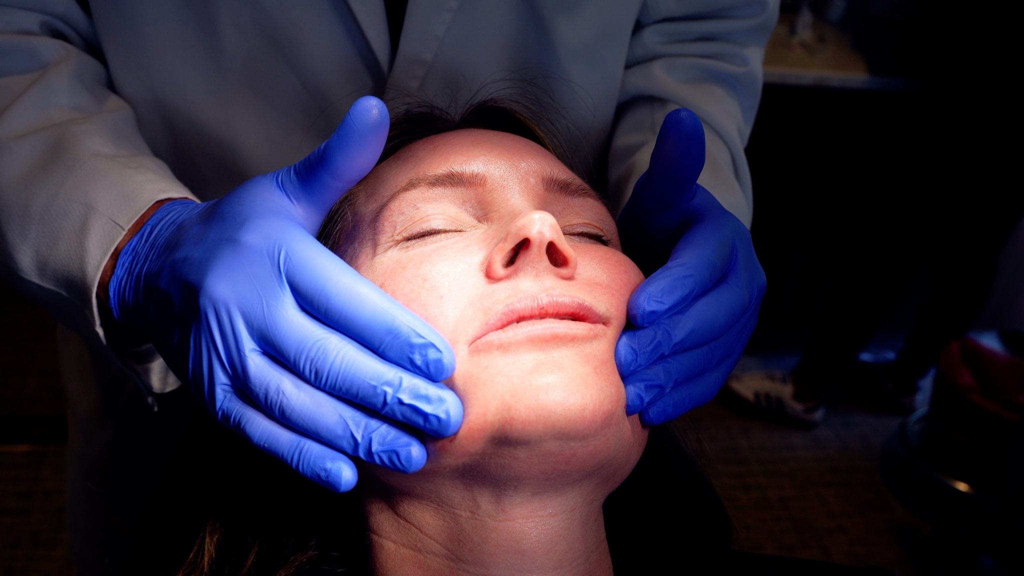 SCULPTRA 1 YEAR AFTER 4 VIALS COMPARISON - treatment image