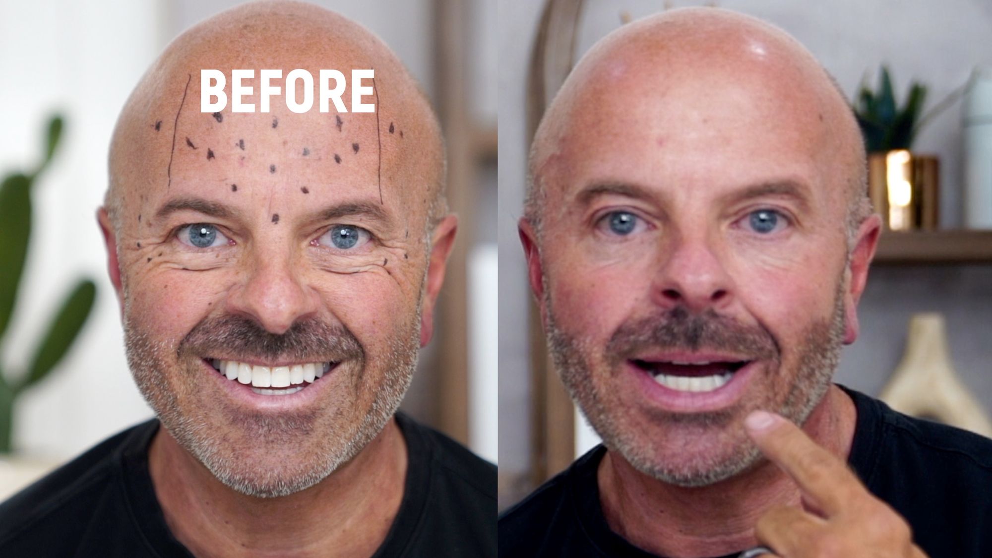 Brotox Breakdown: What You Need to Know About Botox for Guys - treatment image