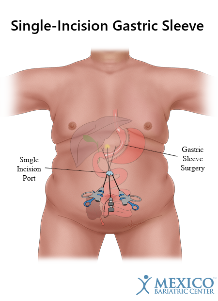 Ozempic weight loss before and after vs Gastric Sleeve: Did Semiglutide Ruin My Hair? - treatment image