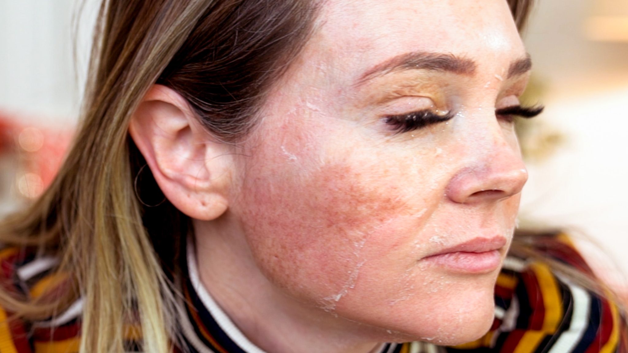 30% TCA PEEL PART 2 – HEALING - treatment image