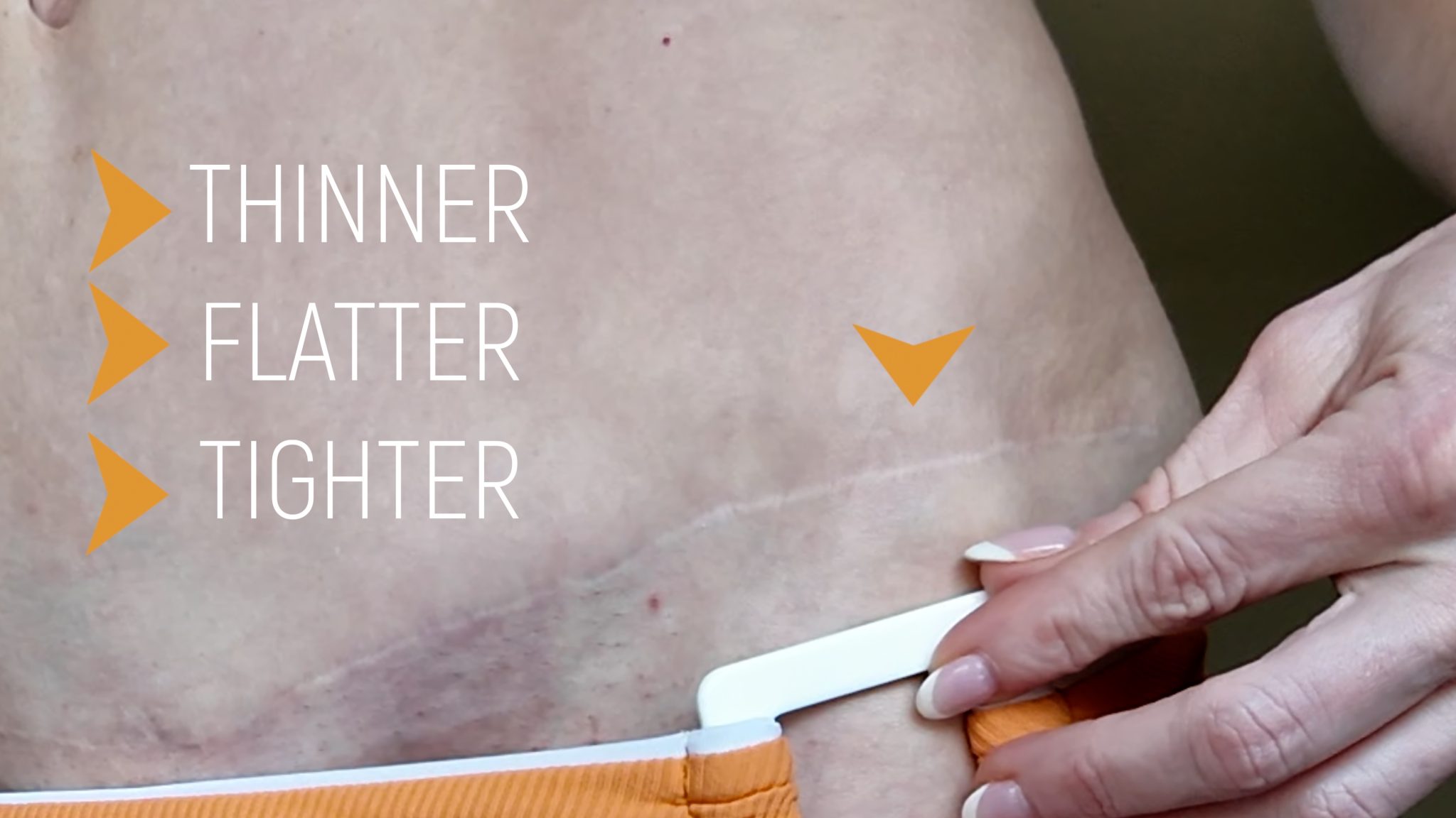 VBEAM LASER BEFORE AND AFTER - treatment image