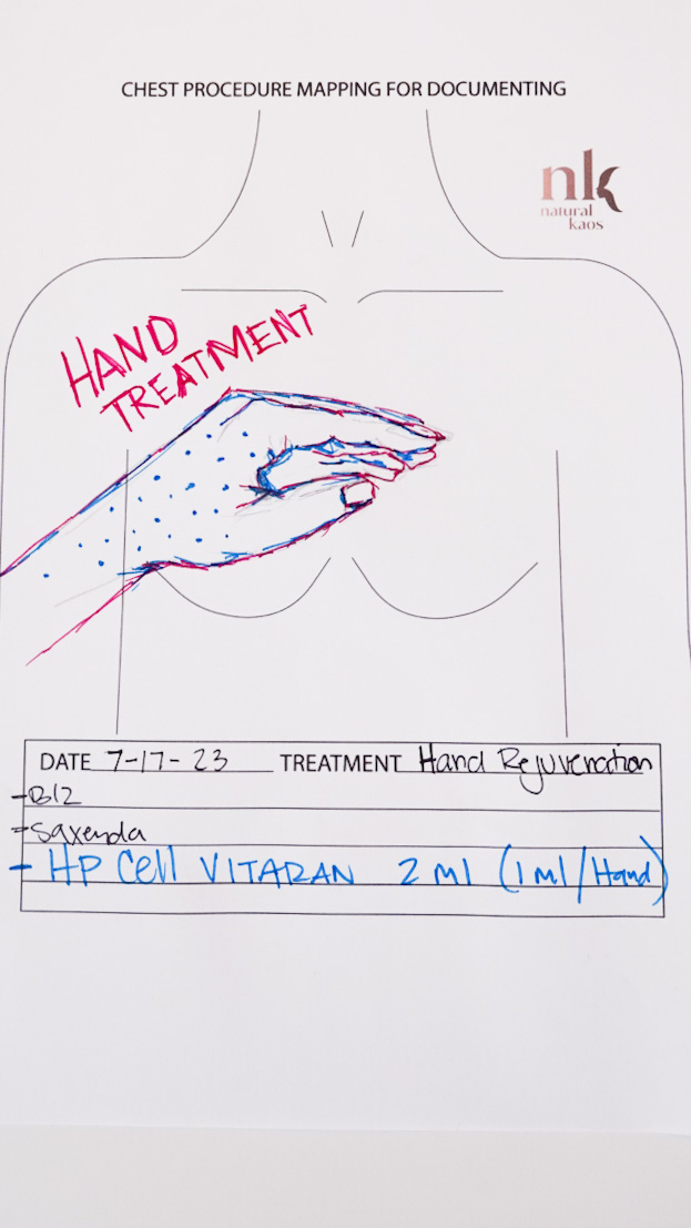 HAND MESOTHERAPY HP CELL VITARAN & INNOTOX INJECTIONS - treatment image