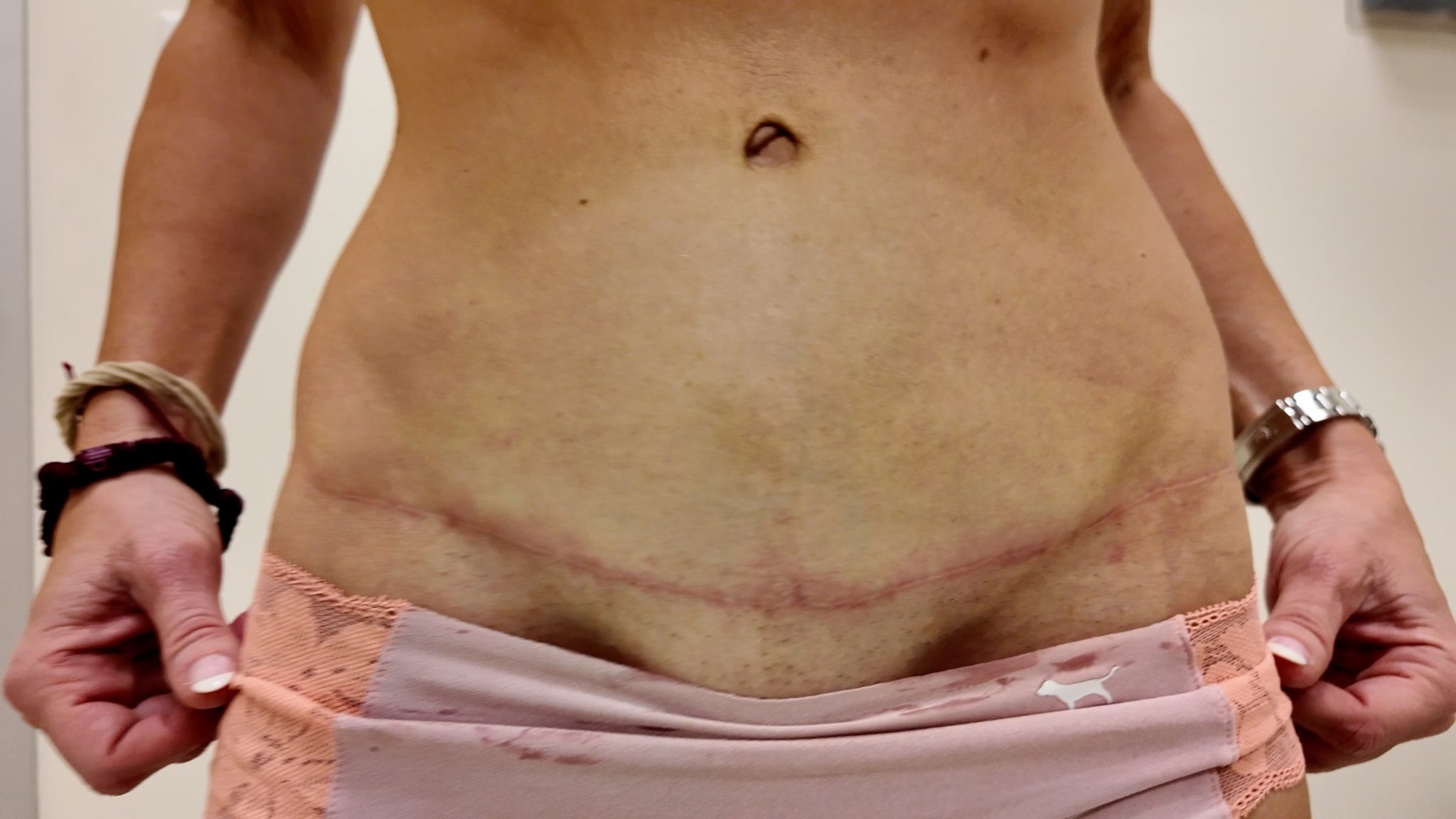 Tummy Tuck Before and After SCAR Check - treatment image
