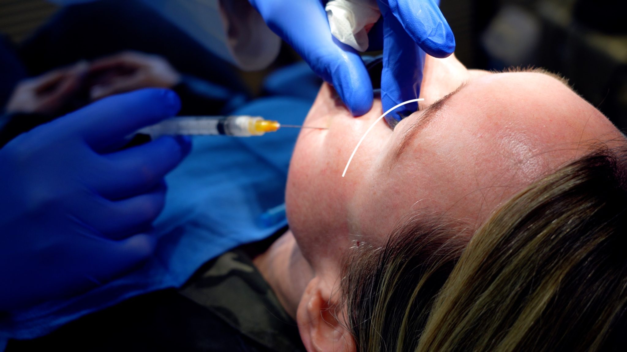SCULPTRA 1 YEAR AFTER 4 VIALS COMPARISON - treatment image
