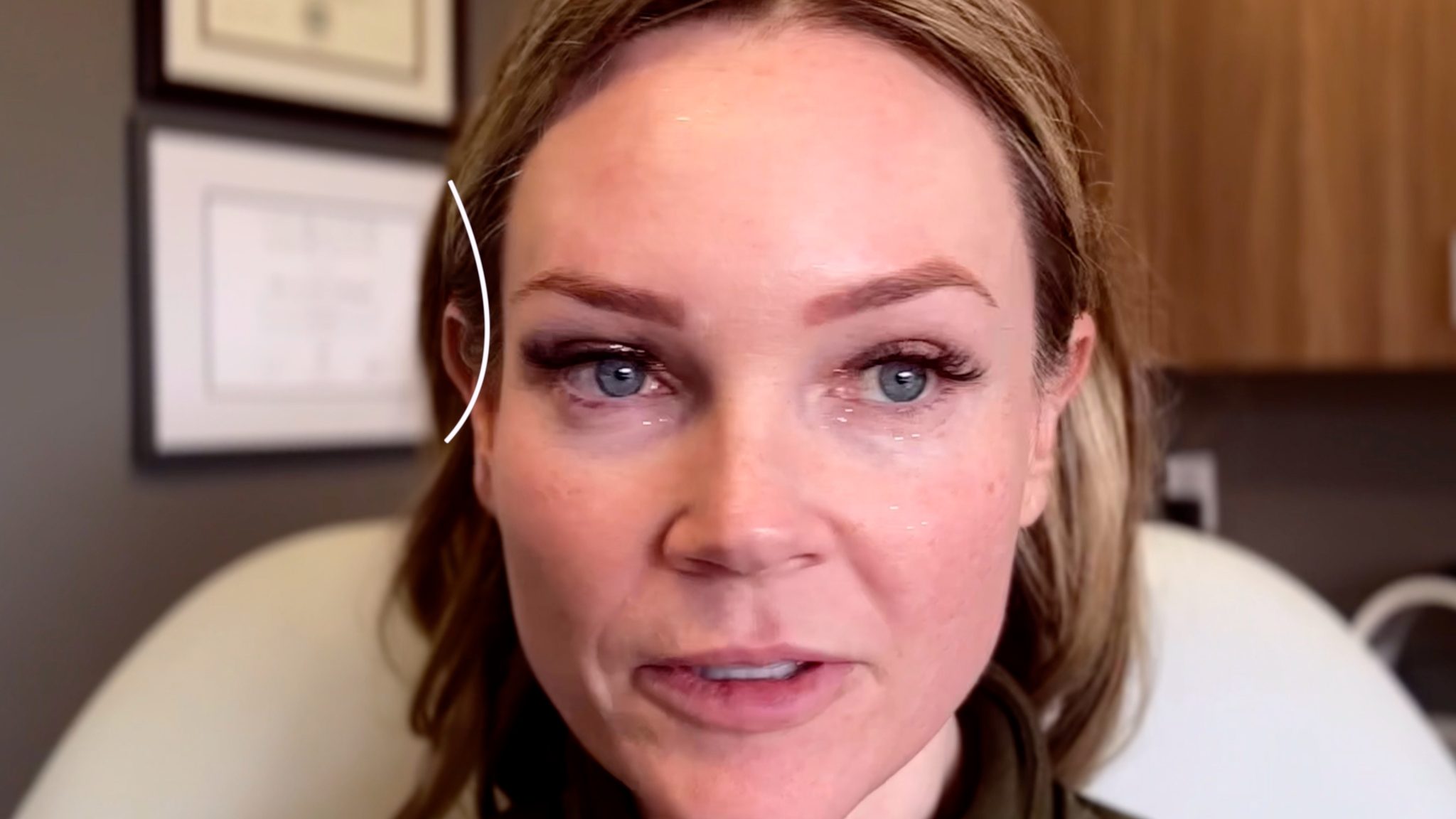 SCULPTRA 1 YEAR AFTER 4 VIALS COMPARISON - treatment image