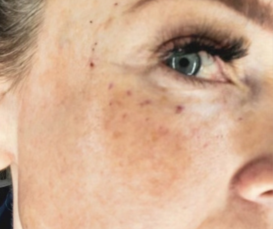 MESOTHERAPY
