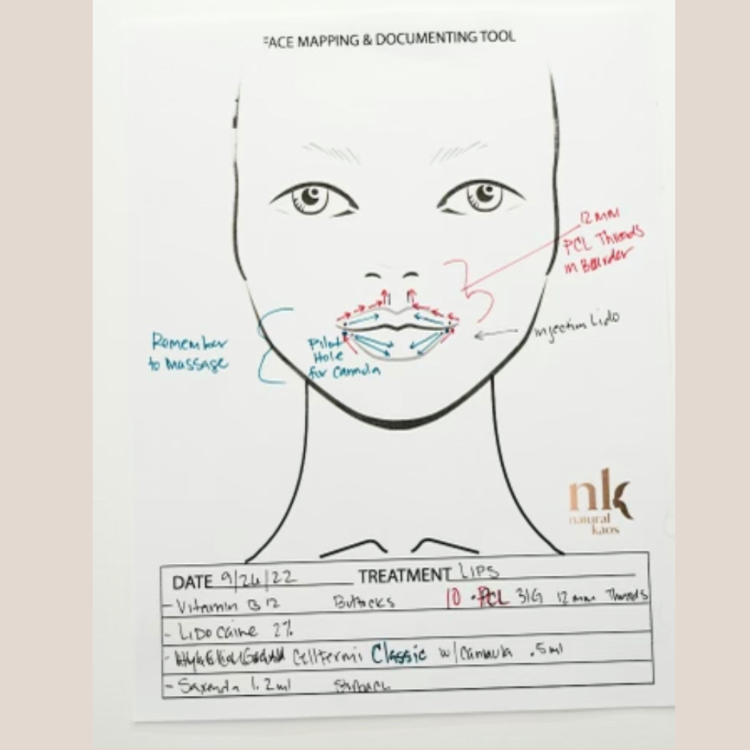 Lip Filler and PCL Threads for Lips Natural Kaos - treatment image