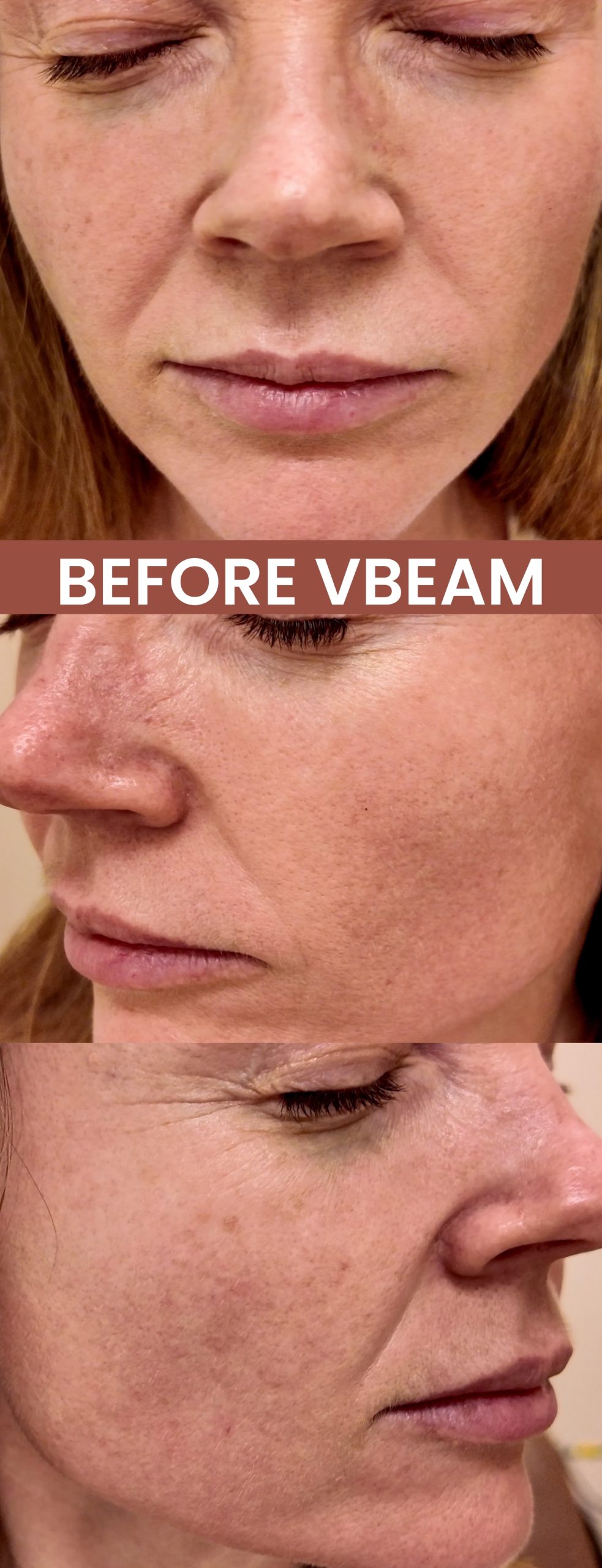 VBEAM LASER BEFORE AND AFTER - treatment image