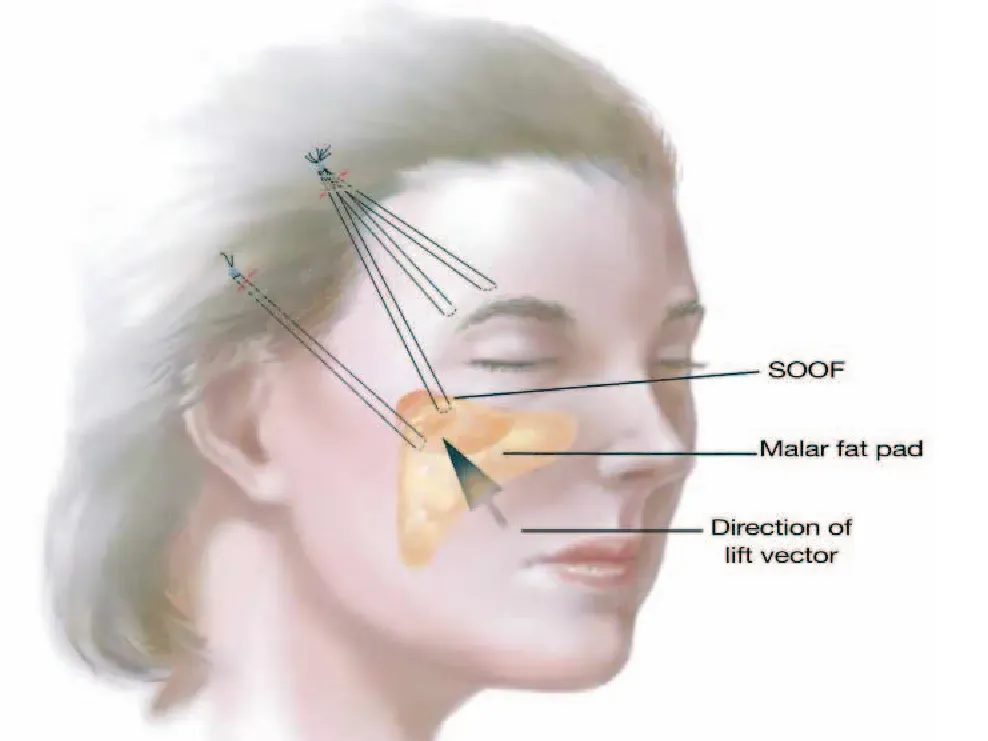 Do I Need a Facelift? Join Me for My Consultation Experience & Cost! - treatment image