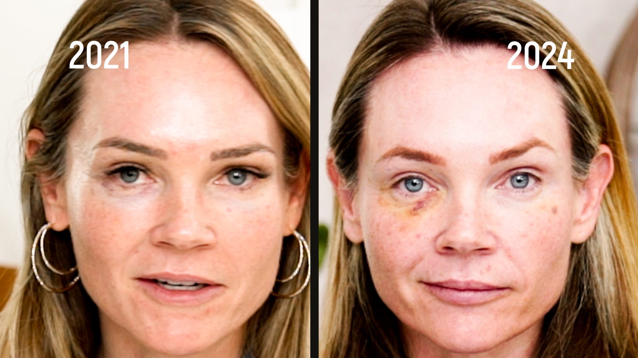 Can you get HIV from a Vampire Facial? Are PRP Injections safe? - treatment image