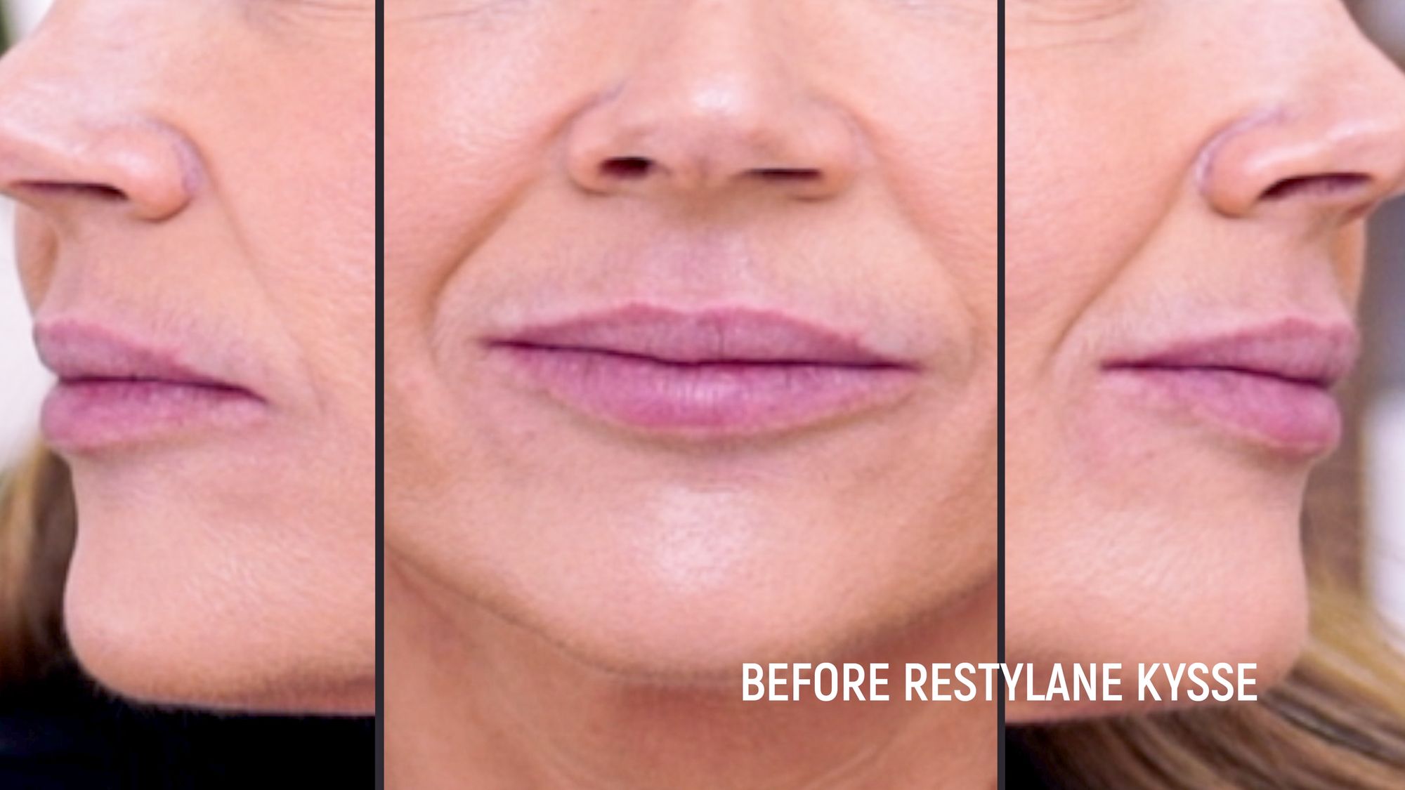 Restylane Kysse Lip Filler: Why the Cannula Method is a Game Changer! - treatment image