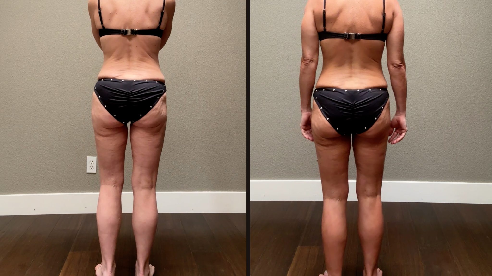 Using Melanotan to Prevent Polymorphous Light Eruption aka SUN POISONING - treatment image