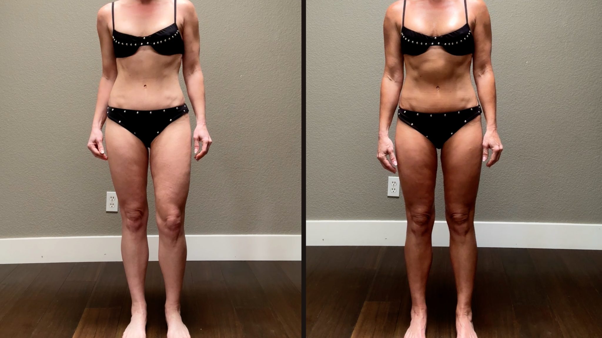 Melanotan 1 vs. 2: My Summer Journey & Real Results - treatment image