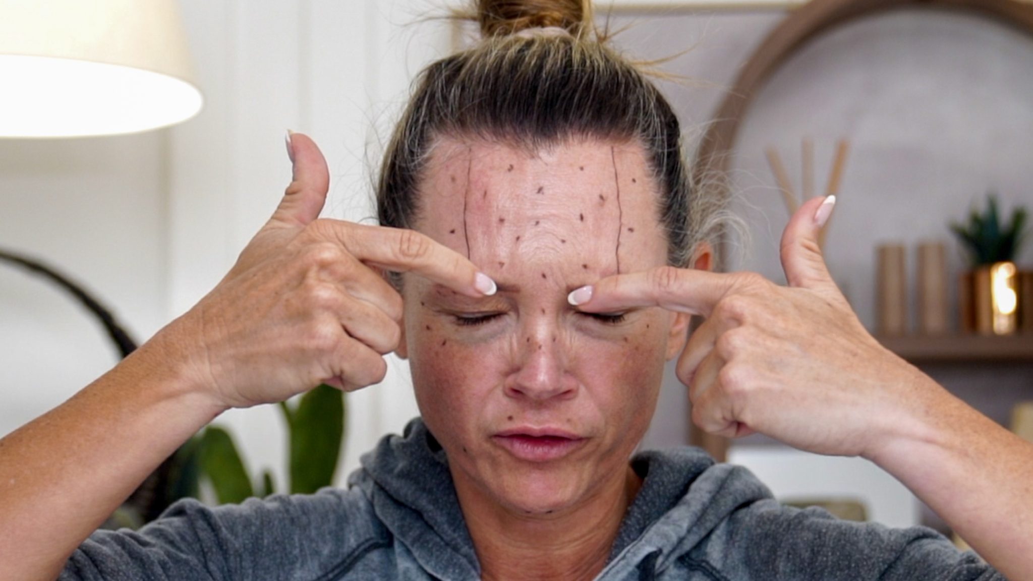 Transform Your Ozempic Face With Innotox And PLLA - treatment image