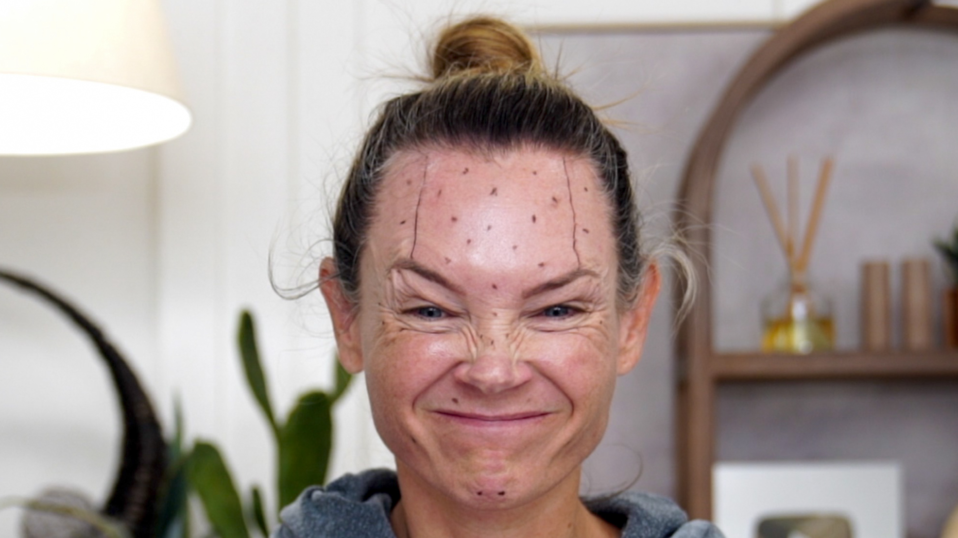 Transform Your Ozempic Face With Innotox And PLLA - treatment image