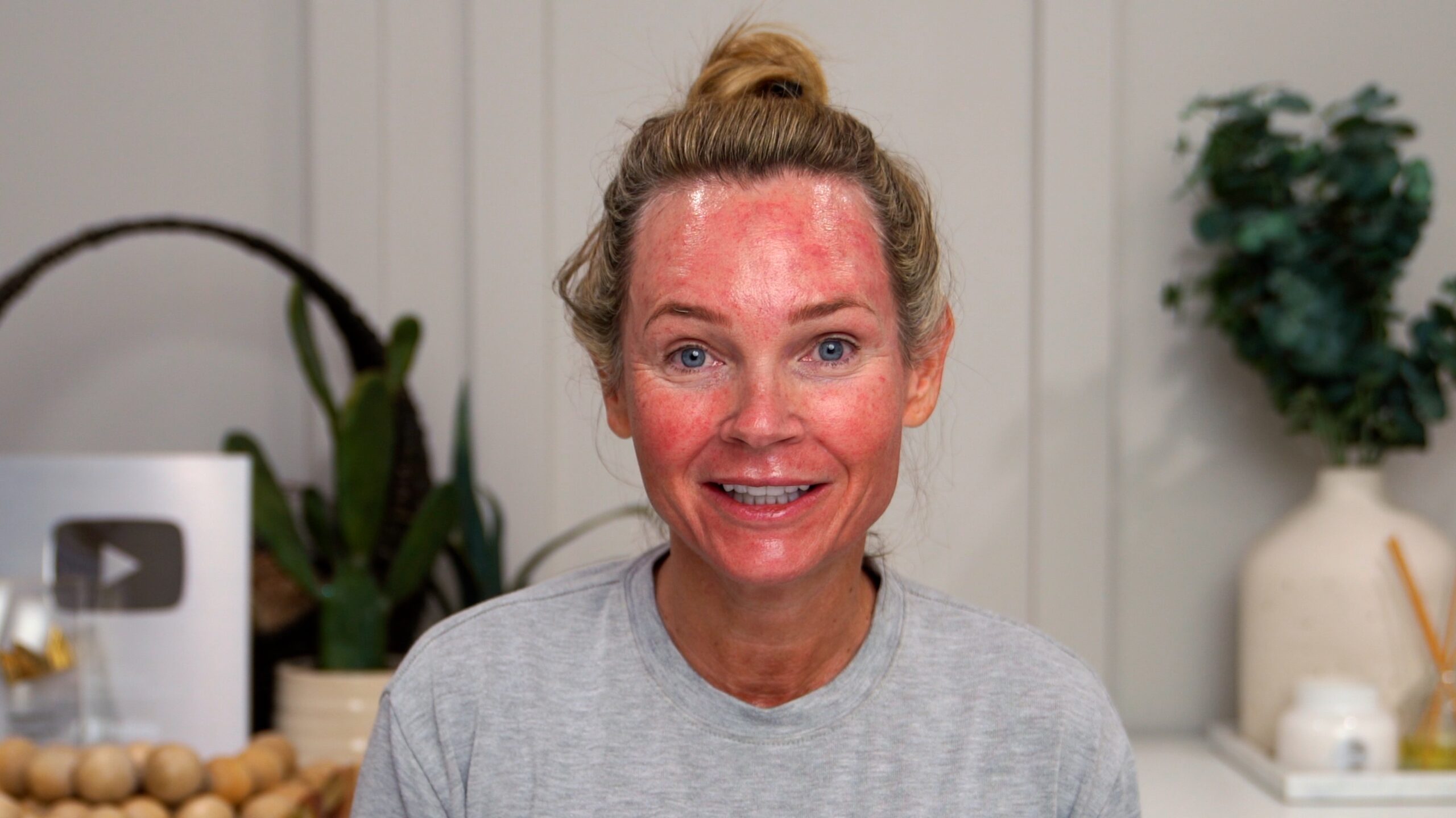 Kim Pratt showing pronounced facial redness on day 1 after 1.6 mm microneedling with the Dr. Pen M9