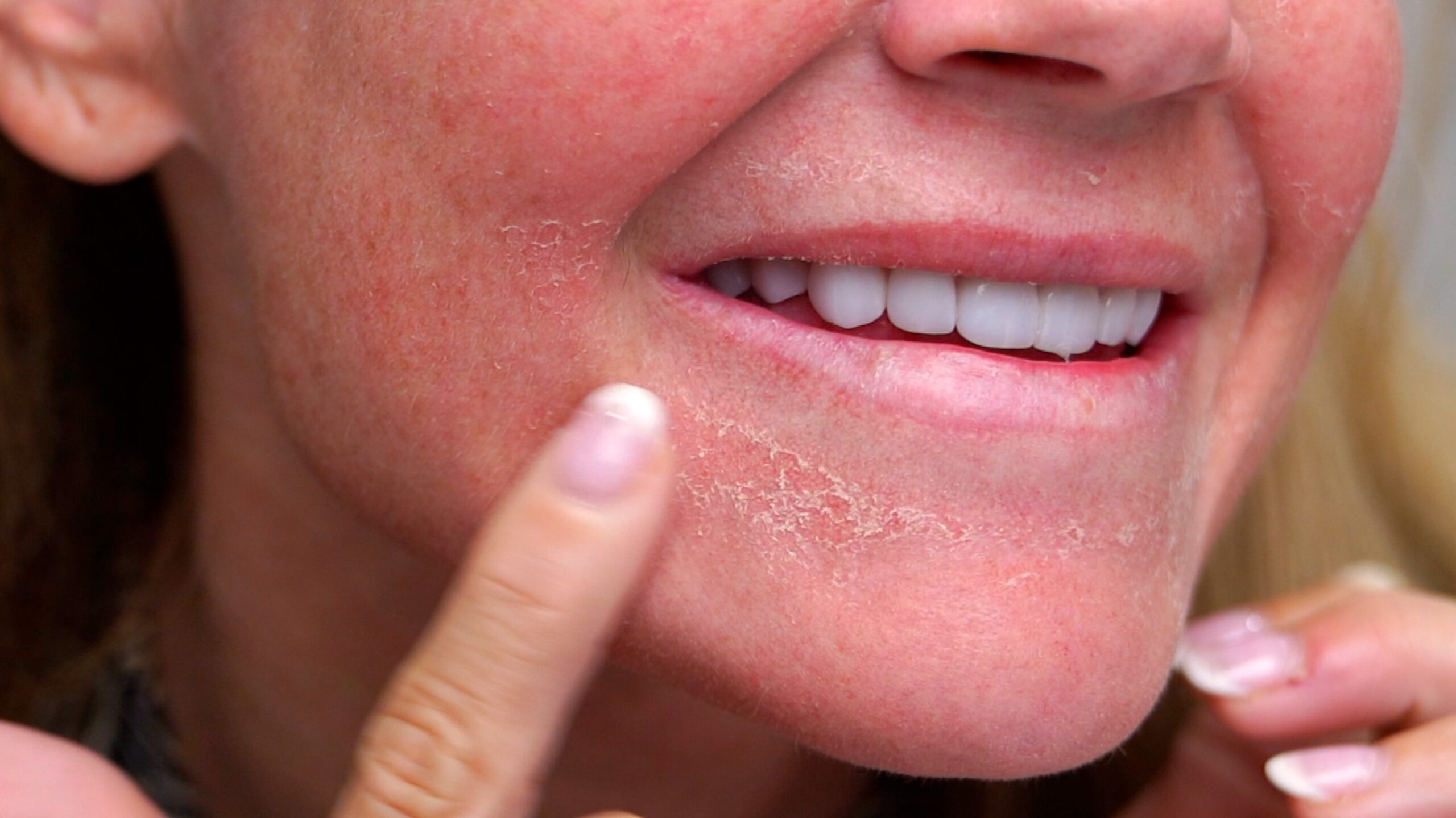 Close-up of visible dry scaling below Kim Pratt’s lip during recovery after facial microneedling