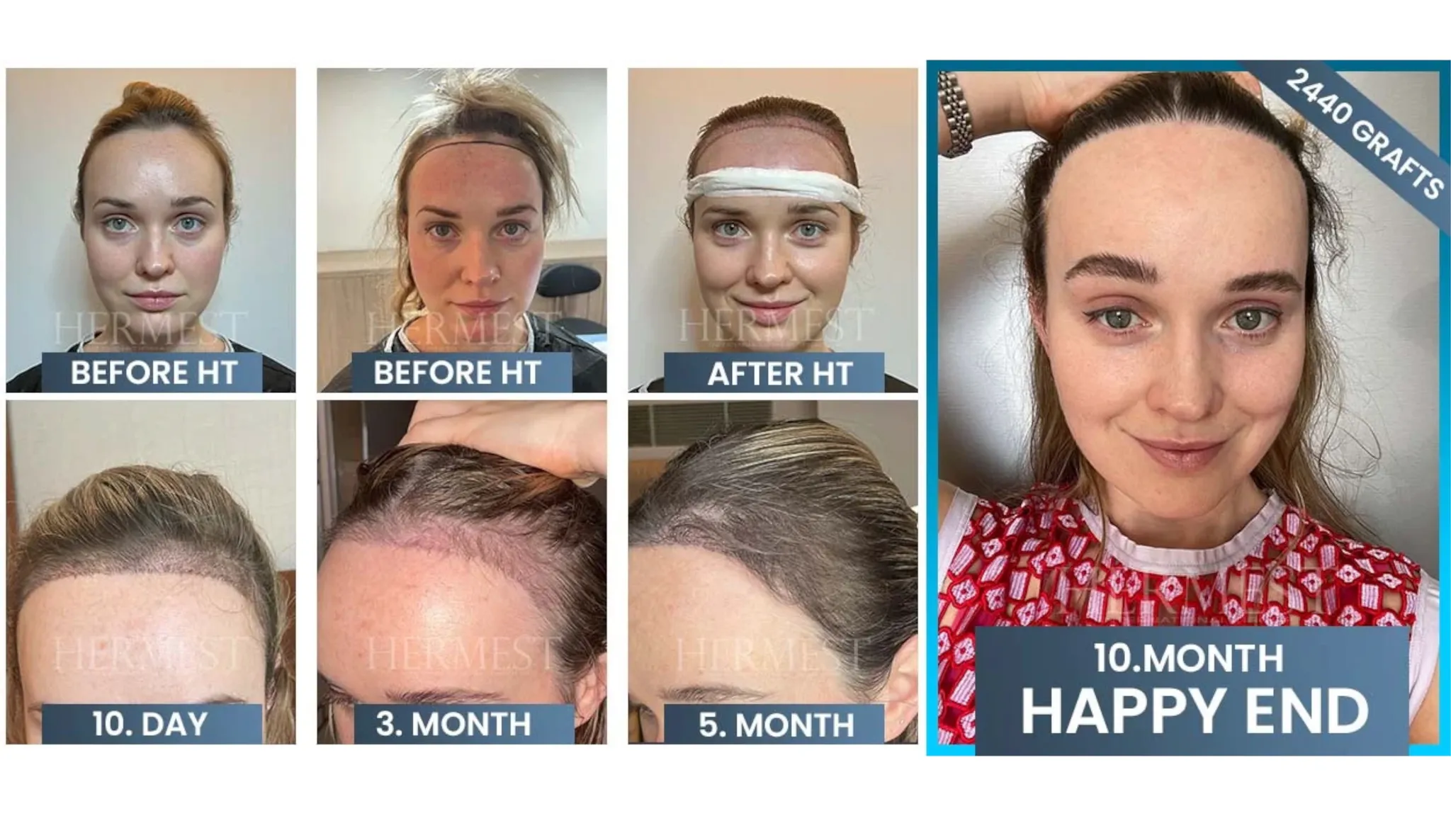 Semaglutide Hair Loss: What REALLY Helped My Hair Grow Back After 9 Months - treatment image