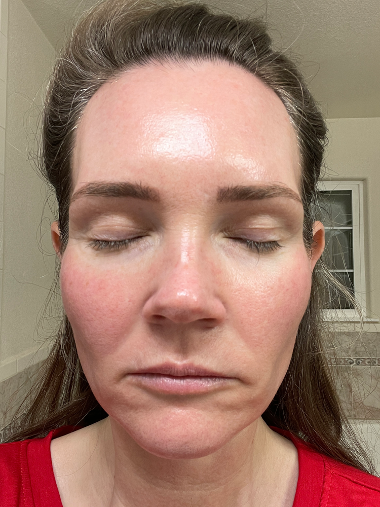 DIY PLASMA LIFT FIBROBLAST DEMO - treatment image