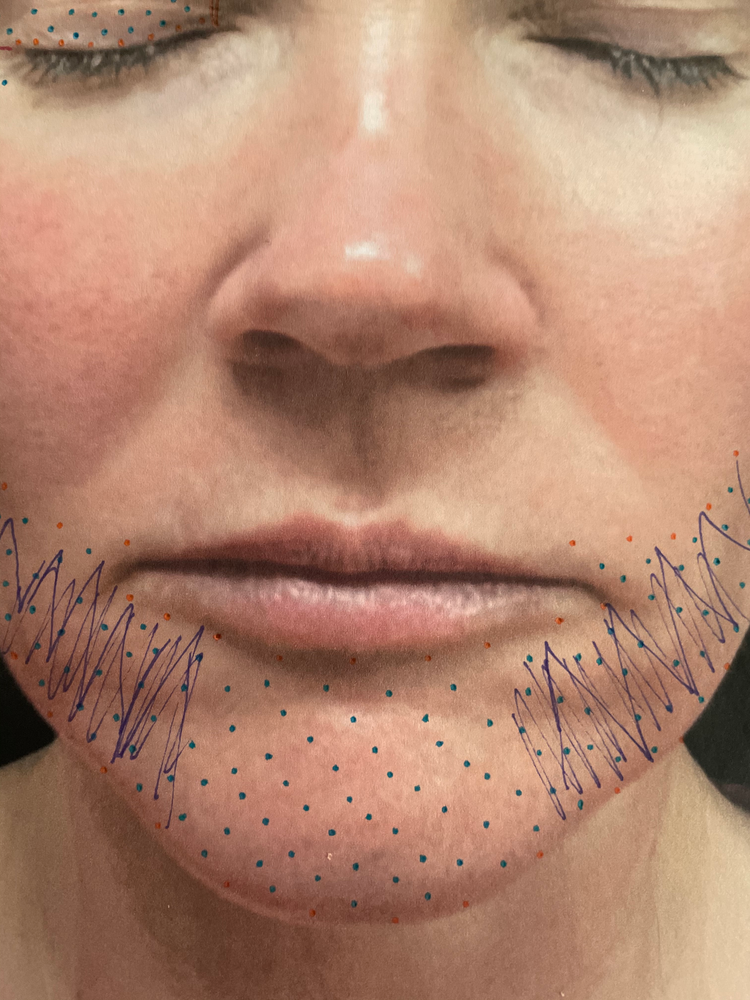 DIY PLASMA LIFT FIBROBLAST DEMO - treatment image