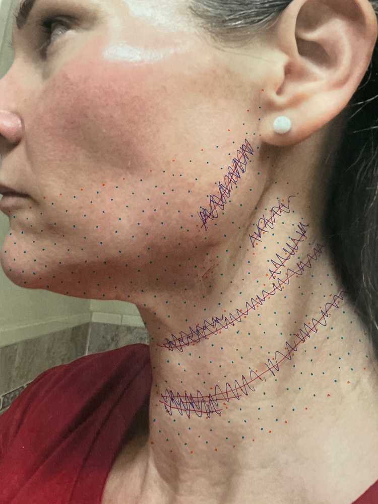 DIY PLASMA LIFT FIBROBLAST DEMO - treatment image