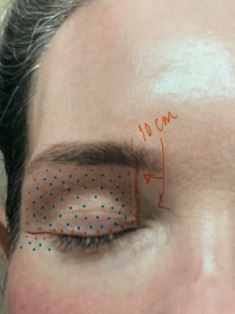 DIY PLASMA LIFT FIBROBLAST DEMO - treatment image