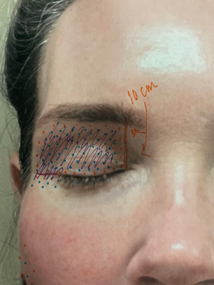 DIY PLASMA LIFT FIBROBLAST DEMO - treatment image
