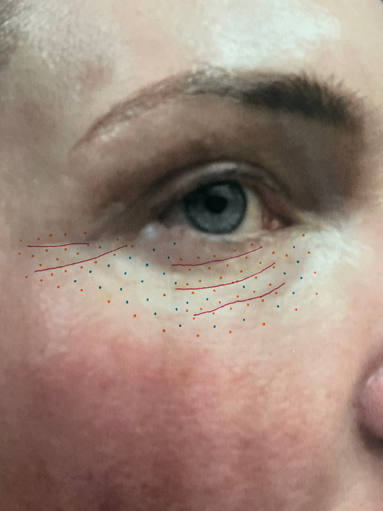 DIY PLASMA LIFT FIBROBLAST DEMO - treatment image