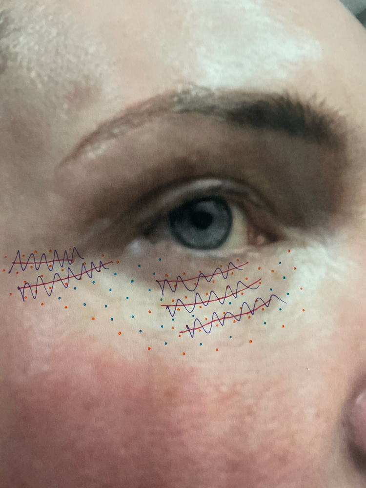 DIY PLASMA LIFT FIBROBLAST DEMO - treatment image