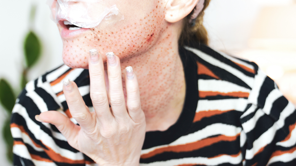 DIY PLASMA LIFT FIBROBLAST DEMO - treatment image